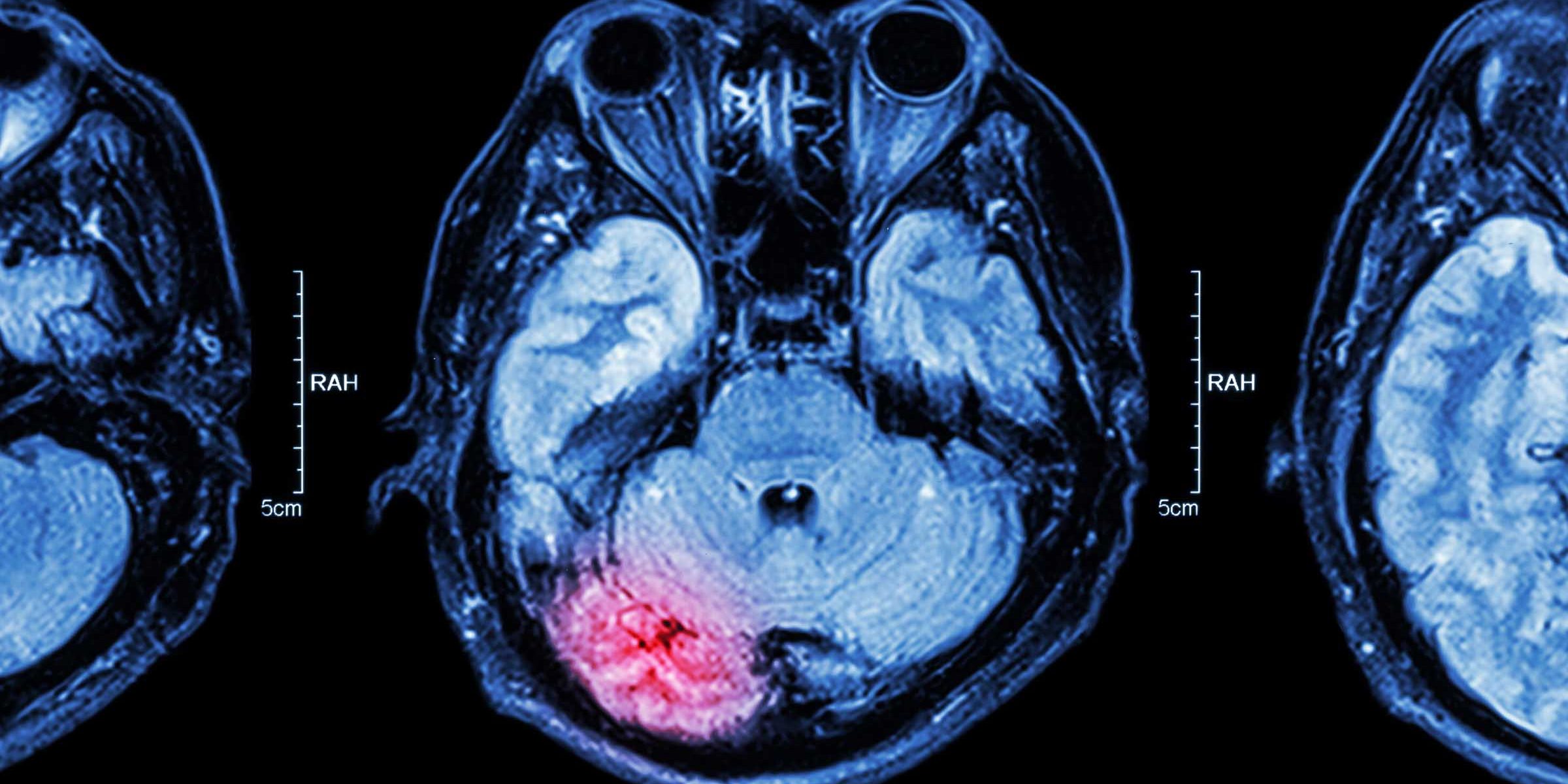 Brain Injury MRI after an accident in a personal injury claim